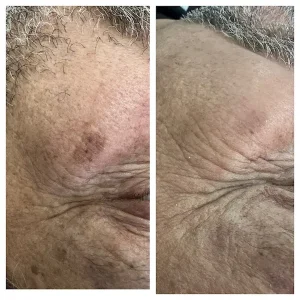 Ankara-Anti-aging cilt sıkılaştırma merkezi.