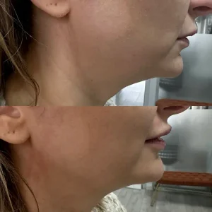 Ankara Q-Lift Anti-aging uygulama merkezi.