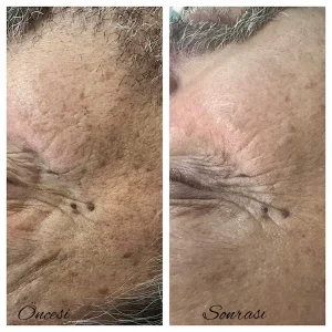 Ankara-Ayrancı Anti-aging cilt sıkılaştırma merkezi.