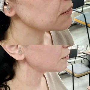 Ankara-Ayrancı Q-Lift Anti-aging uygulama merkezi.