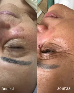 Ankara-Birlik Mahallesi Anti-aging cilt sıkılaştırma merkezi.