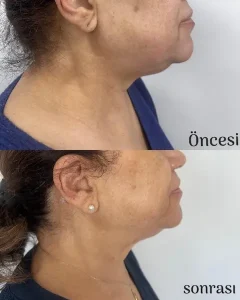 Ankara-Birlik Mahallesi Q-Lift Anti-aging uygulama merkezi.