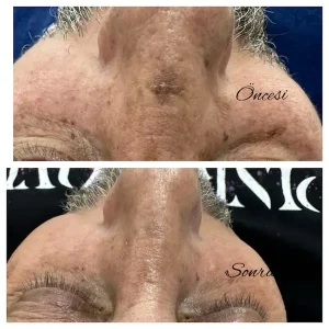 Ankara-Çankaya Anti-aging cilt sıkılaştırma merkezi.