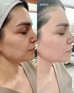 Ankara-Çankaya Q-Lift Anti-aging uygulama merkezi.