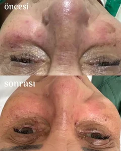 Ankara-Hoşdere Anti-aging cilt sıkılaştırma merkezi.