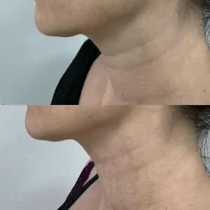 Ankara-Hoşdere Q-Lift Anti-aging uygulama merkezi.