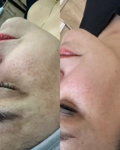 Ankara-Oran Anti-aging cilt sıkılaştırma merkezi.