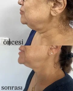 Ankara-Oran Q-Lift Anti-aging uygulama merkezi.