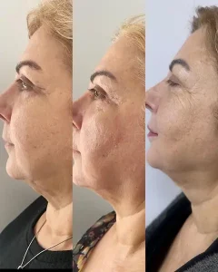Ankara-Yıldız Q-Lift Anti-aging uygulama merkezi.